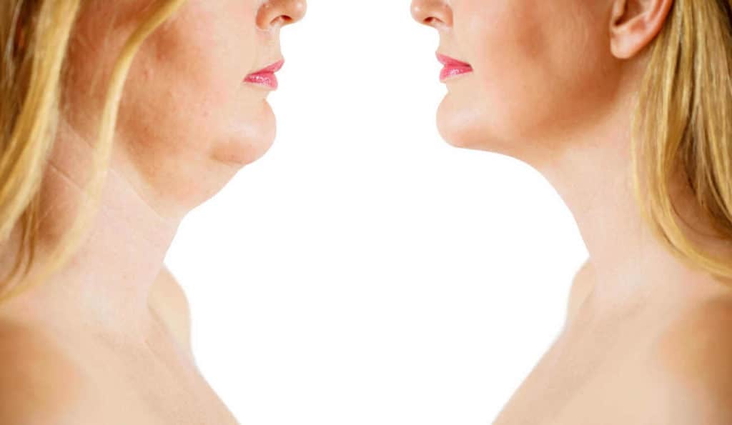 Double Chin treatment Wood Green before and after results