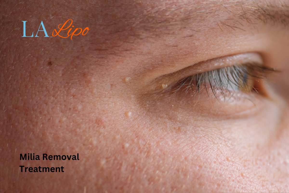Cryopen Milia Removal: Is It the Easiest and Safest Option Wood Green?
