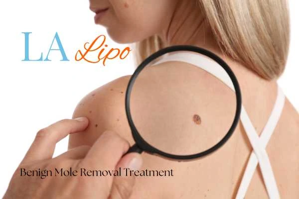 Why getting moles removed Wood Green can boost your confidence!