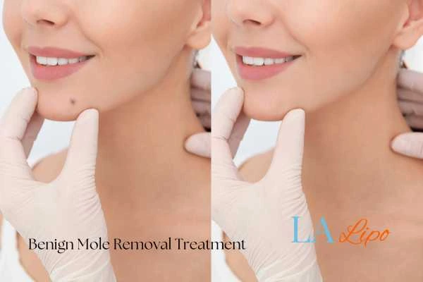 Woman's before and after results of being moles removal treatment Wood Green
