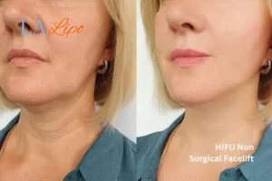 hi-fu for wrinkles Wood Green before and after results