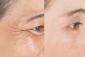 Before and after results of woman - HI-fu wrinkles reduction treatment Wood Green