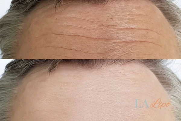 results of HIFU Wood Green on mans forehead to help reduce lines and wrinkles