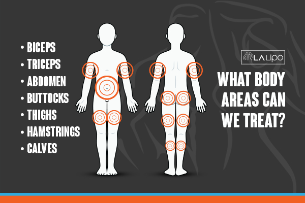 Graphic to show areas you can have LA-EMS Body Sculpting Wood Green treatment.