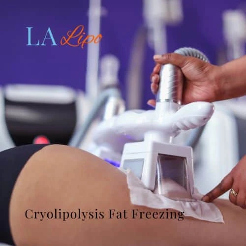 fat freezing - Cryolipolysis Wood Green