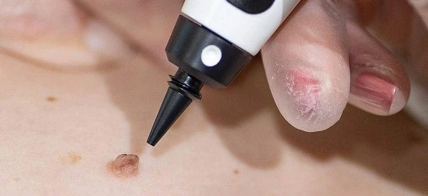 skin tag removal using cryopen Wood Green