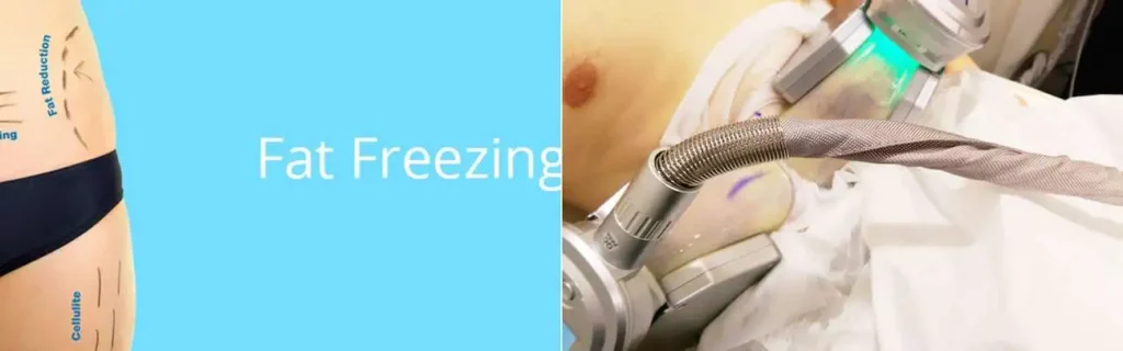 Fat freezing Wood Green on multiple areas of the body