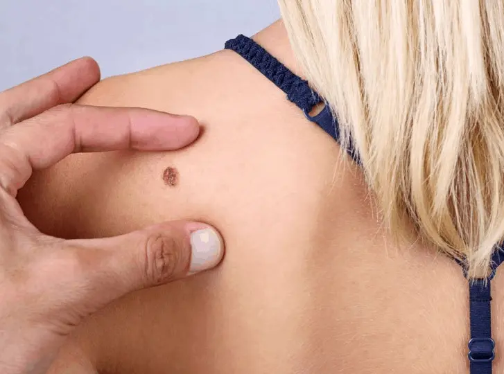 woman having mole removal Wood Green consultation before treatment.