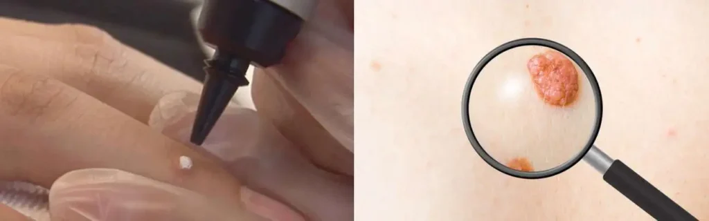 Cryopen for mole removal Wood Green - speak to our team today!