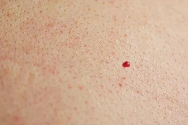 close up of a cherry angioma Wood Green