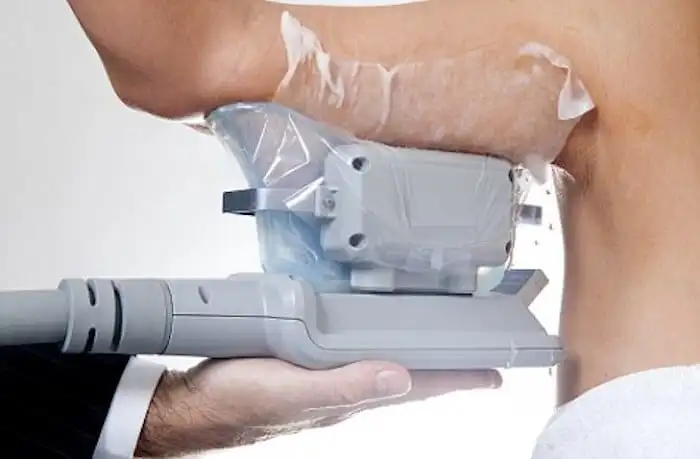 Picture of fat freezing Wood Green on the upper arms.