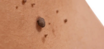 image of a skin tag Wood Green