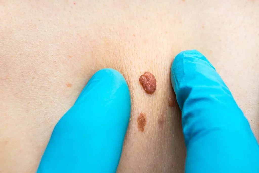 Consultant examining a skin tag Wood Green