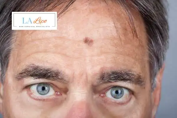 Solar Lentigo Removal Wood Green image of man with mark on his forehead