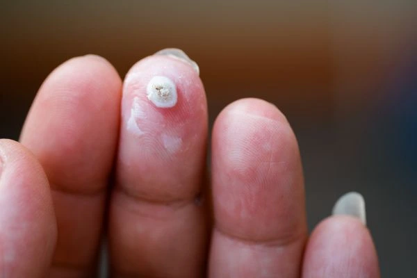 wart on person finger - cryotherapy to treat from LA LIPO Wood Green