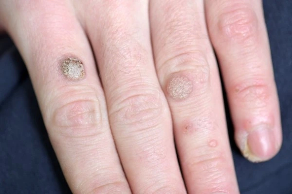 photo of warts on person hand - see wart removal Wood Green from LA LIPO