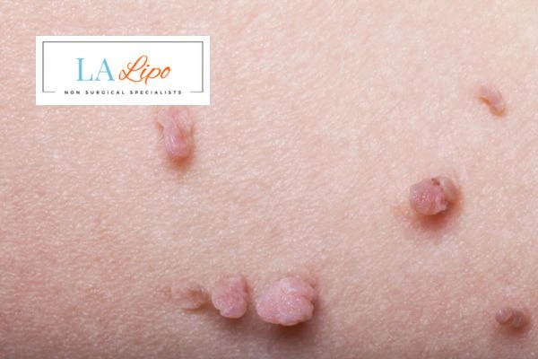 Does cryopen skin tag removal Wood Green hurt? Find out now call our team today!