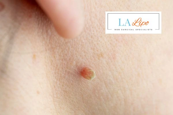 Book skin tag removal Wood Green today speak to our team now!