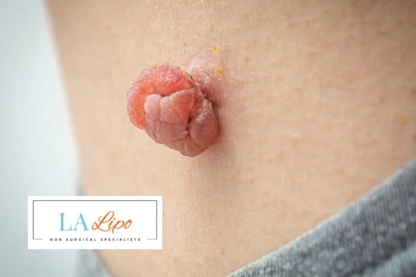 Interested in skin tag removal Wood Green? Concerned about the pain? Find out more today!