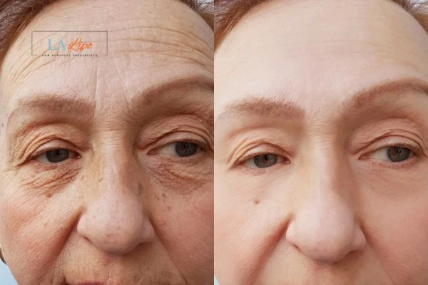 The powerful benefits of Morpheus8 Treatment Wood Green - Call Our team today!