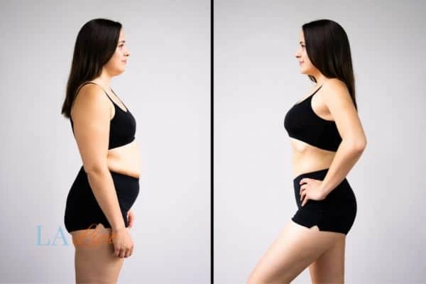 Picture of womans before and after using LA-EMS body sculpting to improve her core strength Wood Green