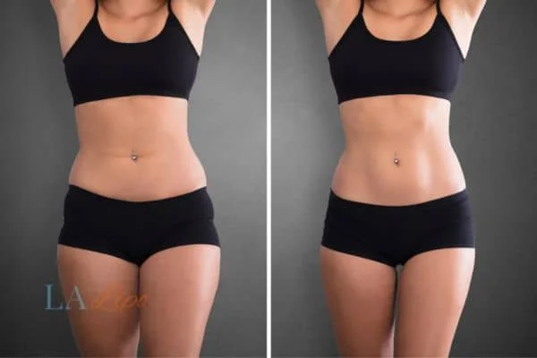 before and after results of non-surgical treatment to help a woman's body image and mental health Wood Green
