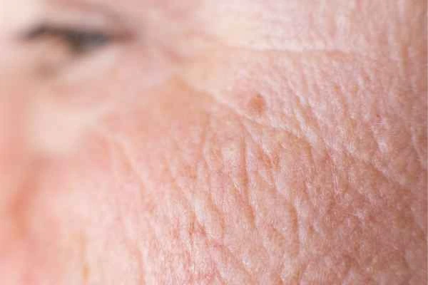close up picture of a woman's face showing an age spot Wood Green