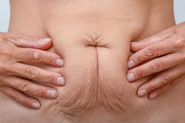 Image of a woman's stomach with loose skin - example of skin tightening Wood Green options