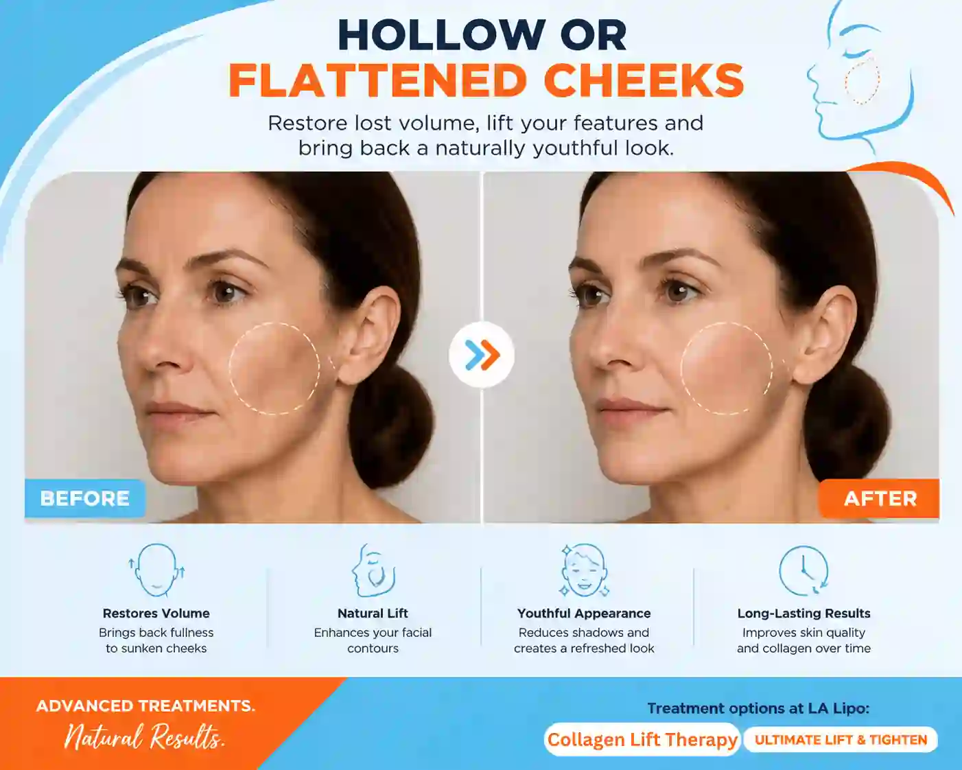 Sign #4: Hollow or Flattened Cheeks Wood Green