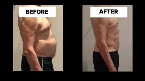 What Symptoms Can Diastasis Recti Cause in Men? Weak Core, Back Pain and Poor Posture Wood Green